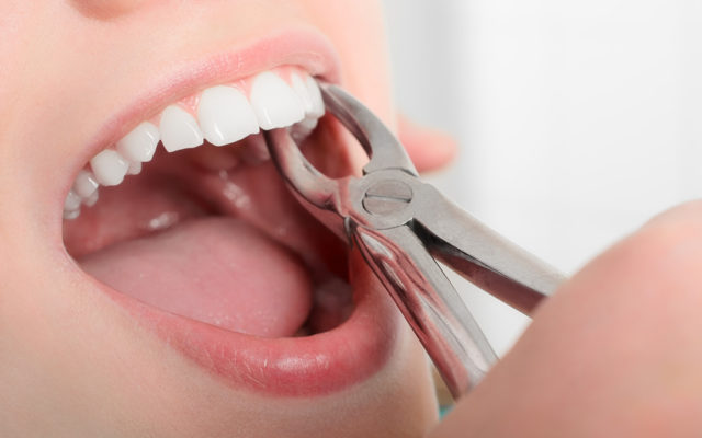 usuwanie zęba kleszczami